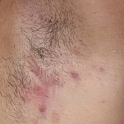 Hidradenite supurativa: entenda os riscos de uma espinha comum se tornar grave