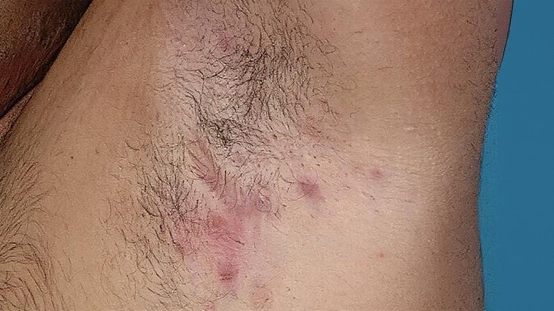 Diagnóstico realizado por avaliação clínica e palpação das lesões (Foto: Reprodução)