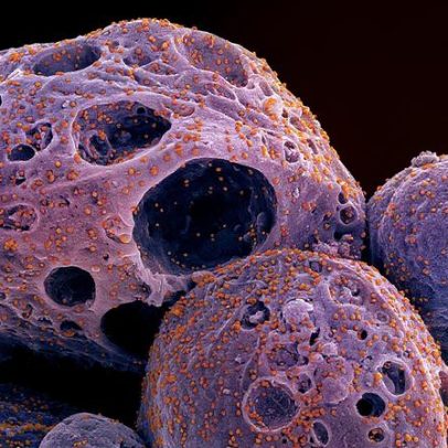 Médicos registram caso inédito de Covid que durou impressionantes 750 dias