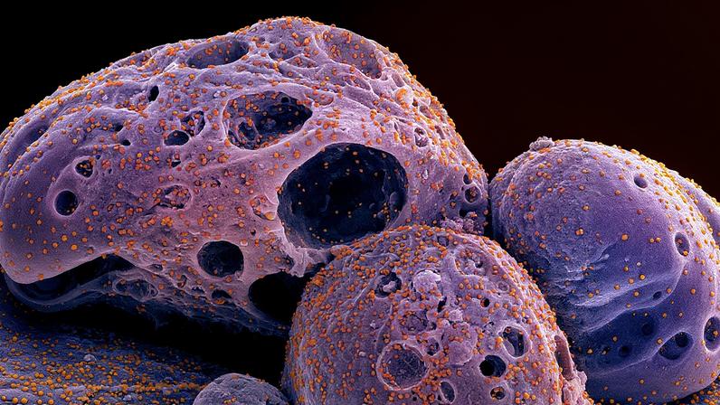 Célula atacada pelo vírus Sars-Cov-2, representado em cores distintas (roxo e laranja) (Foto: Reprodução)