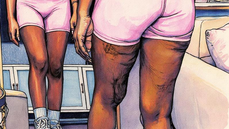 Flacidez atinge muitas pessoas após a perda de peso (Foto: Reprodução)