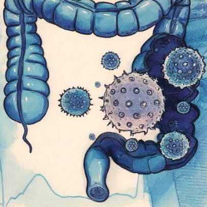 Jovens apresentam maior risco de câncer colorretal agressivo, revela estudo brasileiro