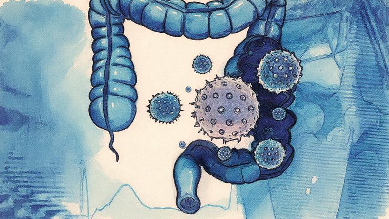 Câncer de intestino apresenta aumento de casos entre adultos jovens, com tumores mais agressivos, segundo pesquisa brasileira (Foto: Reprodução)