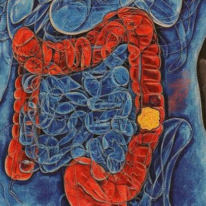 Mortalidade por câncer colorretal cresce 47% em duas décadas, revelam dados