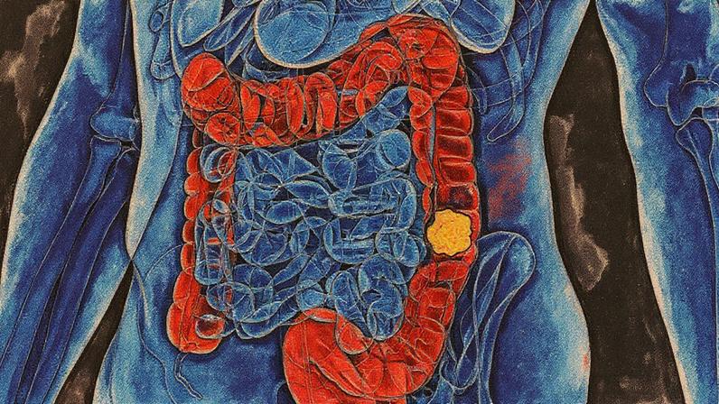 Mais de 24 mil brasileiros morreram em 2023 de câncer colorretal (Foto: Reprodução)