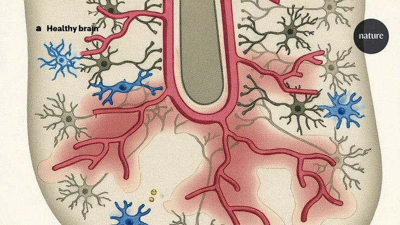 Mudanças nas células cerebrais em atletas expostos a impactos repetidos na cabeça, com perda de neurônios excitatórios e inflamação do microvasculatura (Foto: Reprodução)