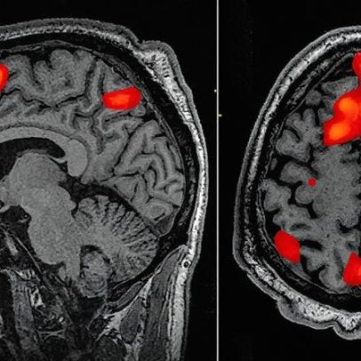 Cientistas tratam com sucesso a doença de Huntington pela primeira vez na história