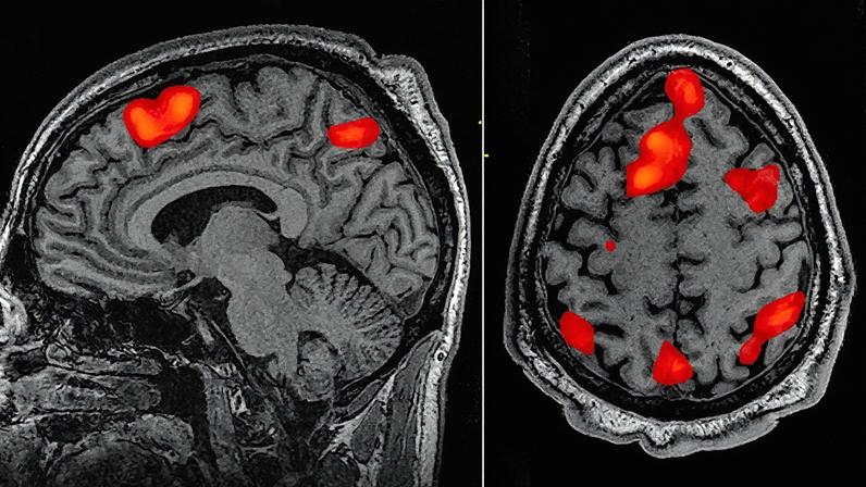 Estimativas indicam que o número de pessoas portadoras do gene da doença de Huntington no Brasil varia entre 13 e 19 milhões (Foto: Reprodução)
