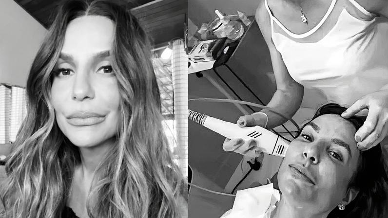 Especialista em estética comenta sobre a popularidade de um procedimento entre artistas (Foto: Reprodução)