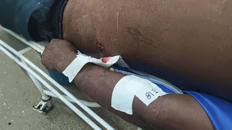 Homem ferido com uma flecha recebe socorro em área rural do Amazonas (Foto: Reprodução)