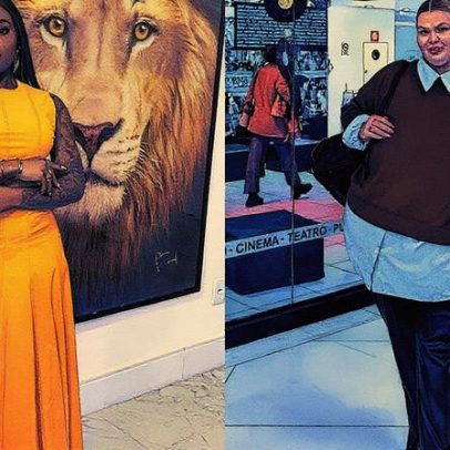 Famosos buscam cirurgias plásticas após bariátrica, revela especialista em estética