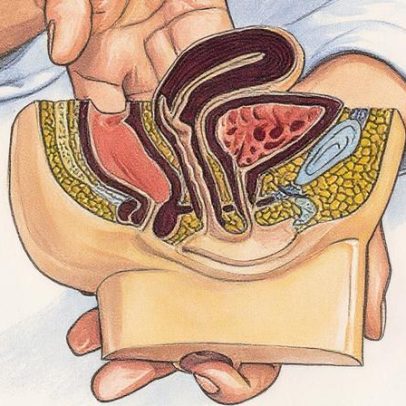 Ancestralidade e genética aumentam risco de câncer colorretal em indivíduos afetados