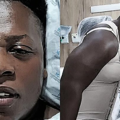 Neném passa por cirurgias estéticas e especialista comenta sobre recuperação e cuidados