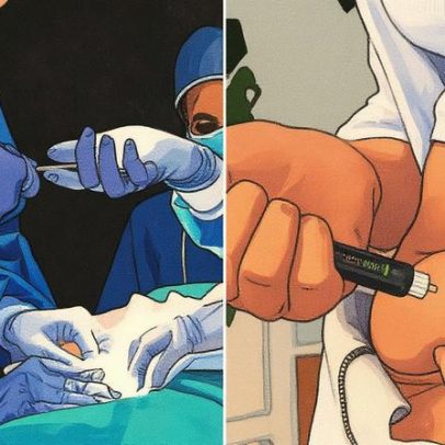 Cirurgia bariátrica supera medicamentos GLP-1 em benefícios para perda de peso