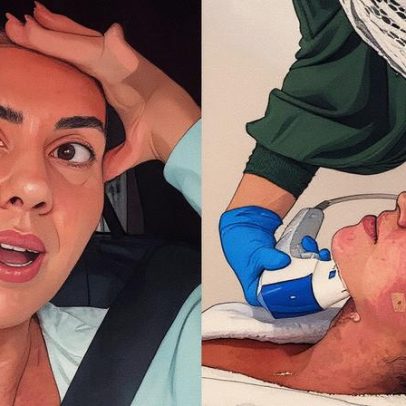 Graciele Lacerda surpreende-se com resultado de procedimento estético