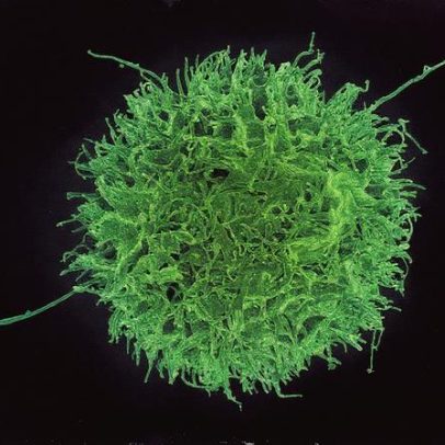 Células NK geneticamente modificadas podem ajudar a combater o câncer