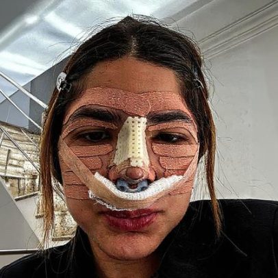 Lary Bottino faz lipo e rinoplastia na mesma cirurgia