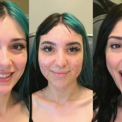 Influenciadora Belle Belinha faz harmonização facial e revela antes e depois