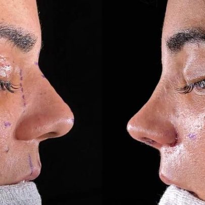 Yasmin Santos exibe resultado de cirurgia no nariz e mostra antes e depois