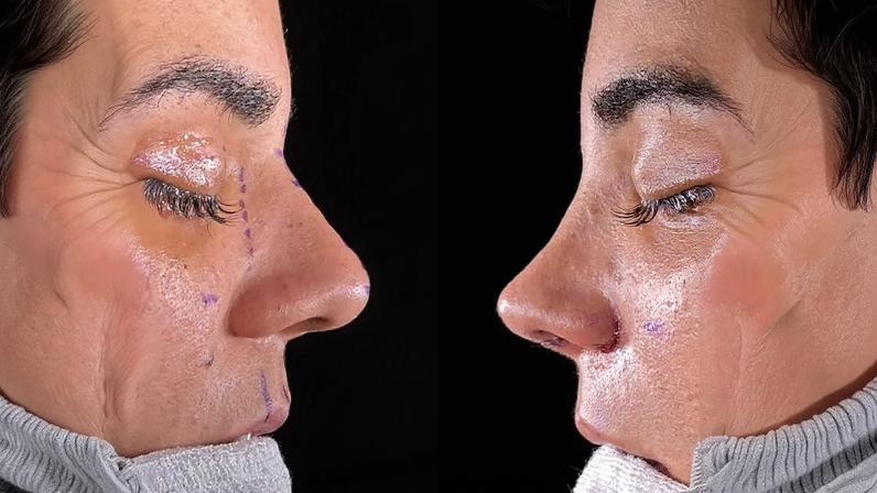 Yasmin Santos mostrou resultado da cirurgia plástica no nariz — Foto: Reprodução/Instagram