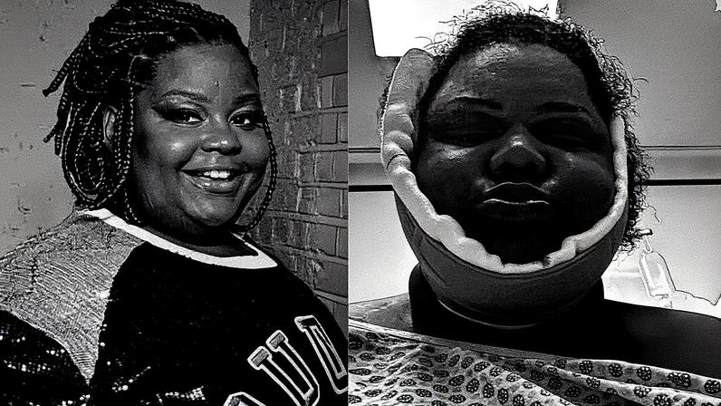 MC Carol passa por cirurgia estética após perder quase 70 kg; veja o antes e depois — Foto: Reprodução/Instagram